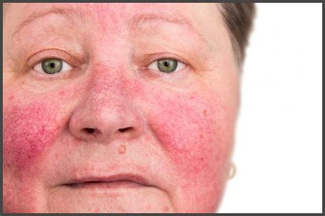 Psoriasis On Face Pictures Psoriasis Expert