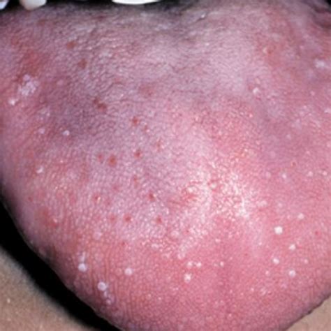 Sore Throat Bumps On Tongue
