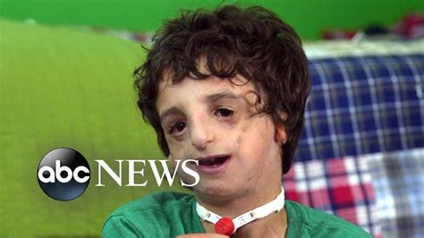 Boy Living With Treacher Collins Has 53 Surgeries By Age 11 2020 Part