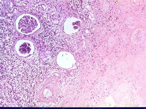 Диета при лимфоме не ходжкина Лимфоузел при лимфоме Ходжкина (№ 90) Лимфоузел при лимфоме Ходжкина (№ 90) Диета при лимфоме не ходжкина