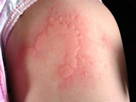 What Are Welts On The Skin What Causes Them To Be Red And Itchy Quora