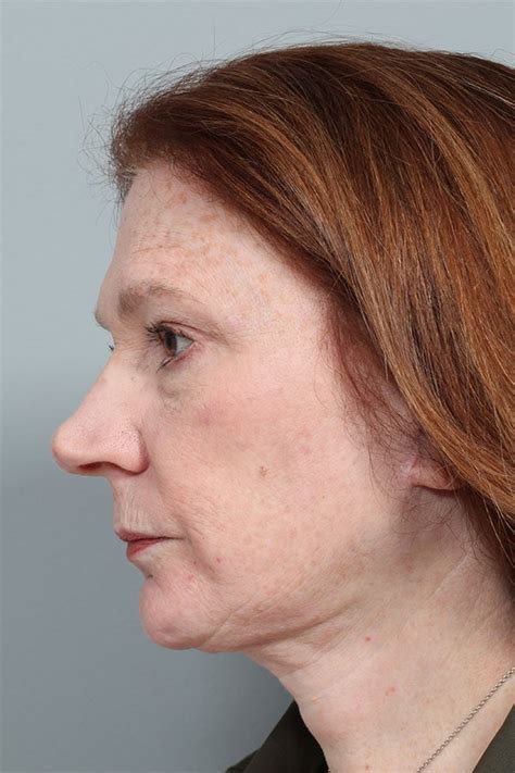 Jowl And Necklift With Liposuction 7451