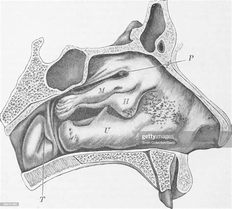 Black And White Print Depicting A Left Nasal Cavity With Lumpy News