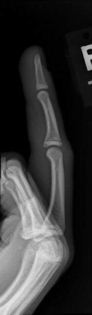 Orthodx Finger Injury In 17 Year Old Patient Clinical Advisor
