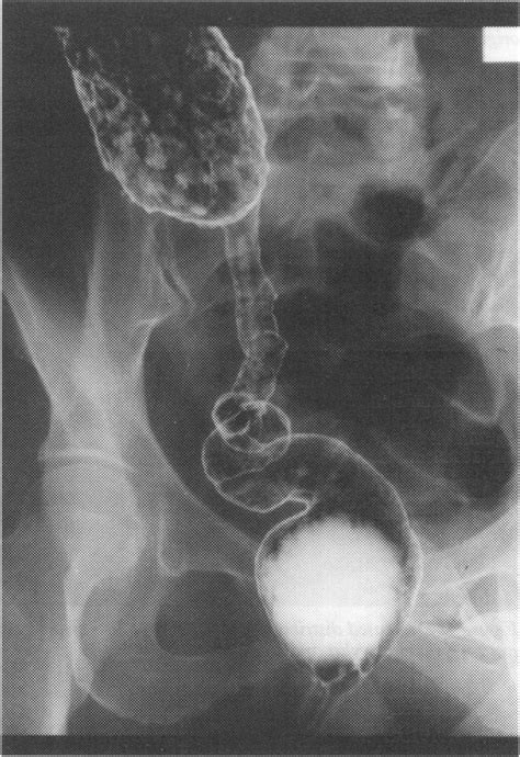 Narrowed Segment Of Rectosigmoid Colon With Normal Appearing Distal