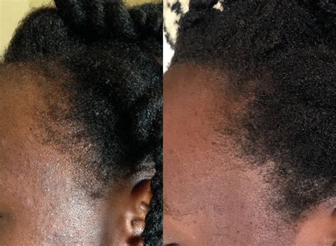 If the edges are mistreated, they can begin to thin out or even bald altogether. Traction Alopecia: How to grow back edges - Kinky Curly Charms