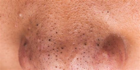 Nose hair shouldn't be trimmed too clean nose hair serve to protect the delicate membranes of the nose trimmer more efficient than scissors back to my nose hair. How to Get Rid of Blackheads on Your Nose | Men's Health