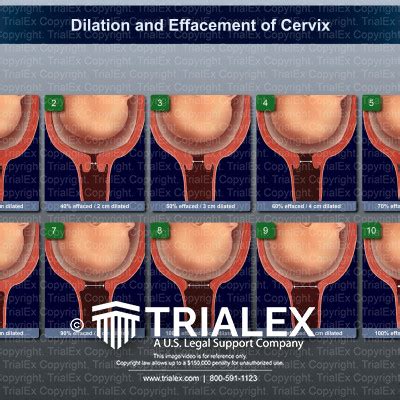 Dilation And Effacement Of Cervix TrialExhibits Inc