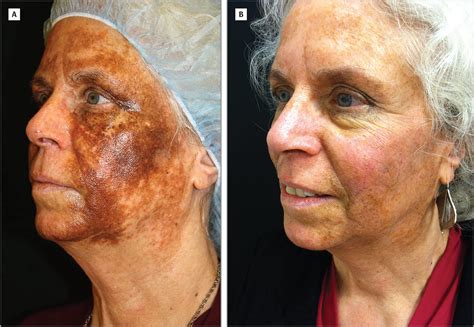 Successful Treatment Of Disfiguring Hemosiderin Containing