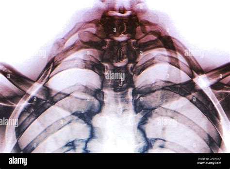 Extra Rib Coloured Frontal X Ray Of A Section Through The Chest Of A