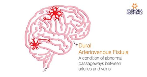 Dural Arteriovenous Fistula Symptoms Causes And Treatment