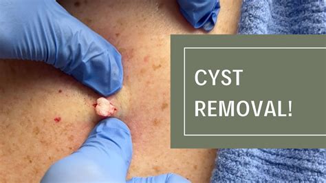 Cyst Removal Dr Derm Youtube