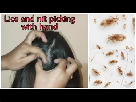 Real Lice And Nit Picking With Hand How To Pick Nits And Lice YouTube
