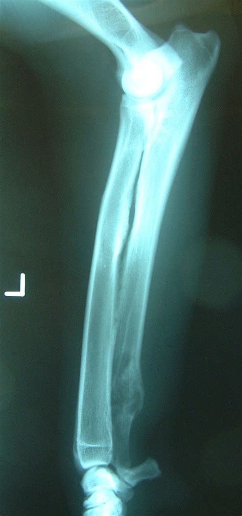 Bone Tumors Ulnar — Dr Julius Liptak