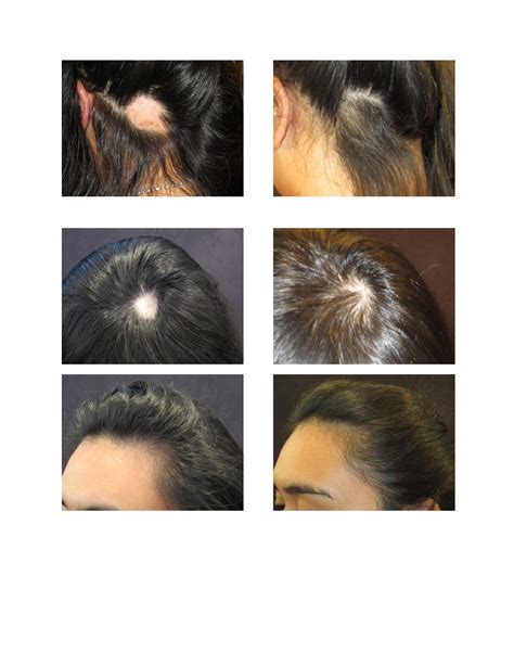 Alopecia Areata And Hair Loss Treatments With Trichologist