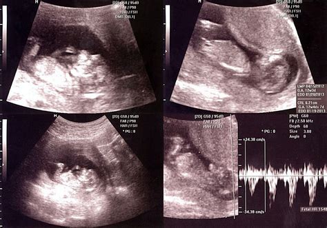 Our Little Hill Hey Baby 12 Week Ultrasound