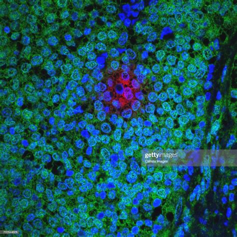 Microscopic Image Of Breast Cancer Cells Resisting Treatment High Res