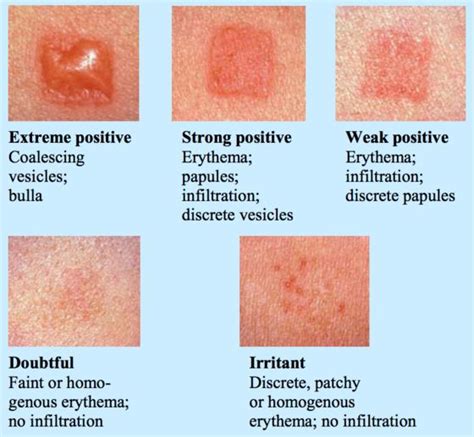 Contact Dermatitis Suddenly And Blue And On Pinterest