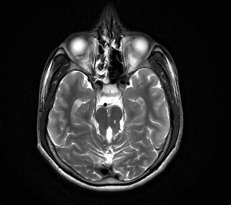 Cureus Diagnosing Joubert Syndrome In Two Adult Siblings A Very Rare