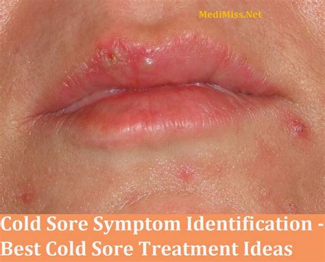Cold Sore Symptom Identification Best Cold Sore Treatment Ideas