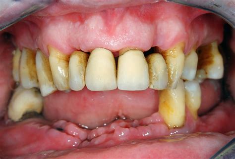 Periodontitis Associated With Increased Risk Of Developing Age Related