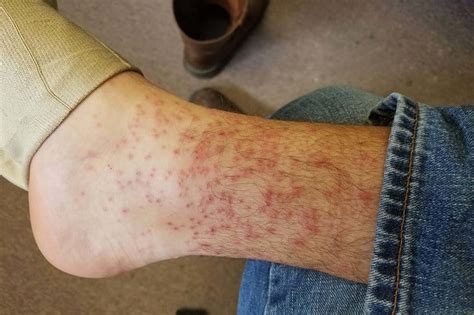 We are going to teach you how to get rid of chigger bites fast and easy through a few simple. How Long Do Chiggers Live on Your Skin? | Skin Care Geeks