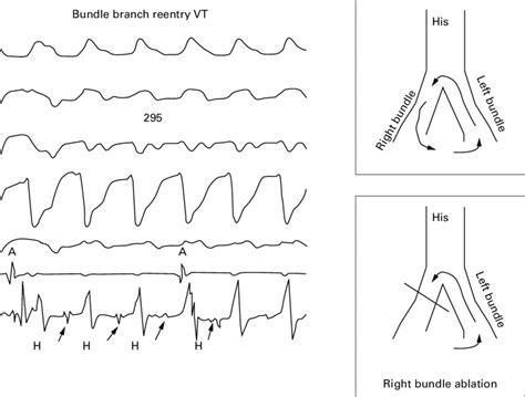 Bundle Branch Re Entry Tachycardia The Left Hand Panel Shows Bundle Download Scientific