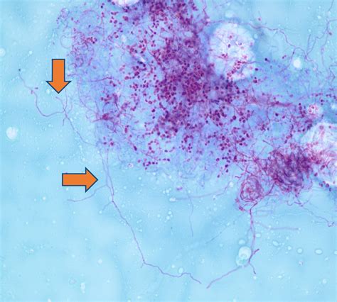 Gram Staining Of Right Middle Lobe Mass Revealed Branching
