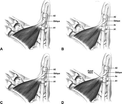 Flexor Pulley System Anatomy Injury And Management Journal Of Hand