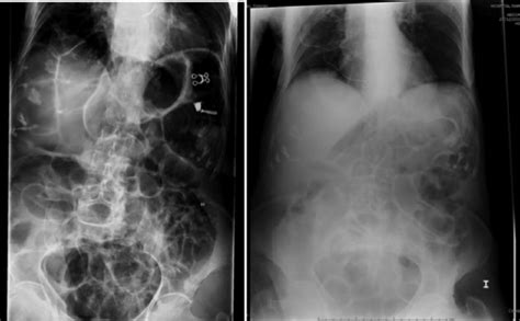 Abdomen X Ray At The Diagnosis Left And Three Days After Epidural