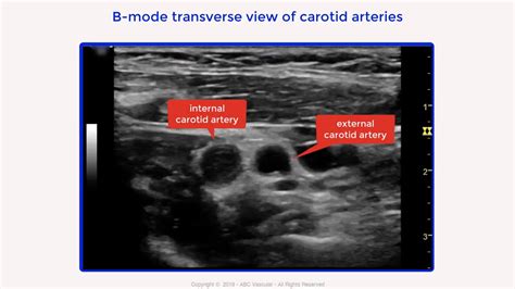 Internal Carotid Artery Chronic Occlusion B Mode And Colour Doppler