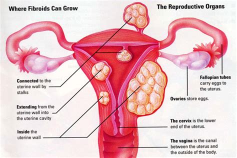 Fibroid atau leiomyomata adalah ketumbuhan abnormal yang membesar dalam rahim. Simptom Cyst, Fibroid — Apa Kesan Pada Wanita Dan Ibu ...
