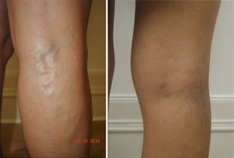 Sclerotherapy Or Laser Treatment For Varicose Veins Which Is Better