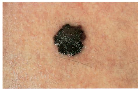 Pictures Melanoma Skin Cancer Moles