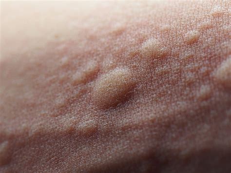 Hives Urticaria Symptoms Causes Treatment And Photos