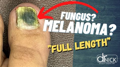 What Causes A Black Toenail Fungus Melanoma Youtube