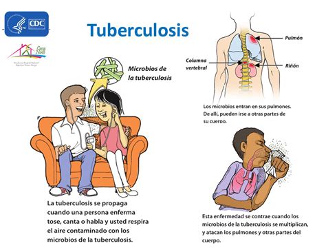 Sintomas De Tuberculose Infantil