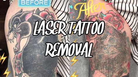 Does laser tattoo removal really work? Laser Tattoo Removal | Session 1| DOES IT HURT??? - YouTube