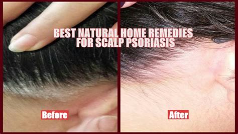 Best Natural Home Remedies For Scalp Psoriasis Youtube
