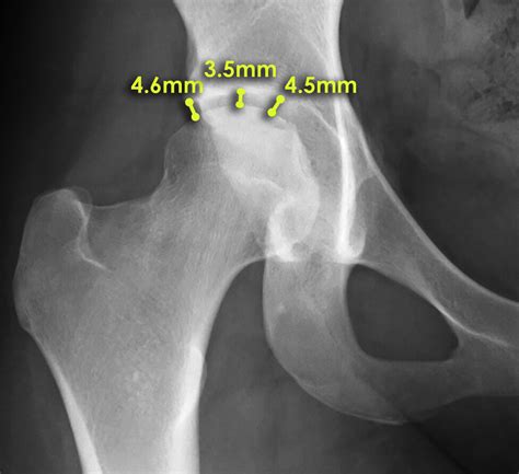 Comprehensive Clinical Evaluation Of Femoroacetabular Impingement Part