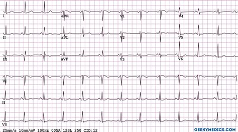 Understanding An Ecg Ecg Interpretation Geeky Medics