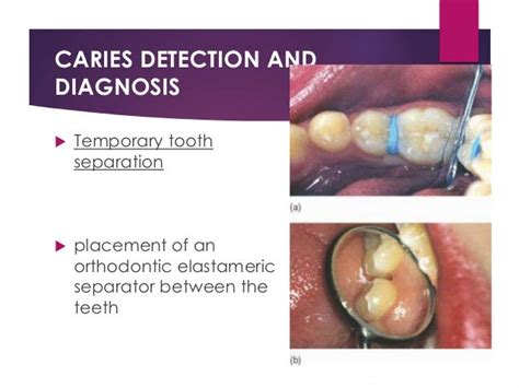 Detection Diagnosis And Prevention Of Dental Caries