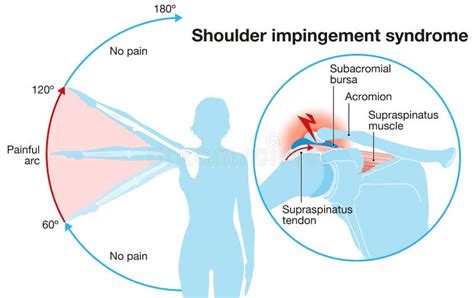Shoulder Impingement Syndrome Rubbing Rotator Cuff Outline Diagram
