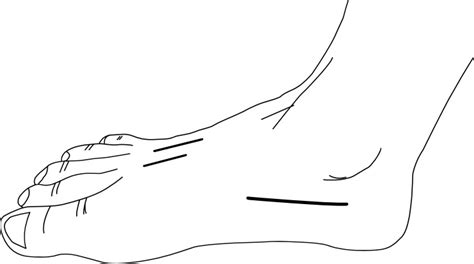Incisions For Foot Fasciotomy Download Scientific Diagram