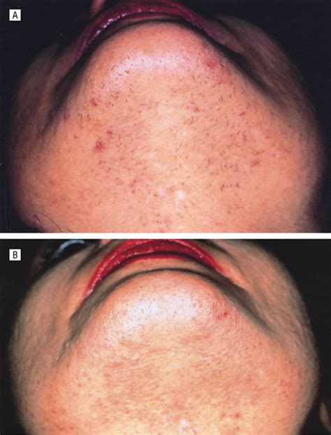 Treatment Of Pseudofolliculitis With A Pulsed Infrared Laser