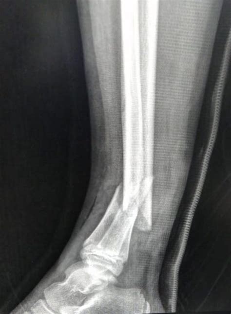 Case Open Tibial Shaft Fracture In An 11m