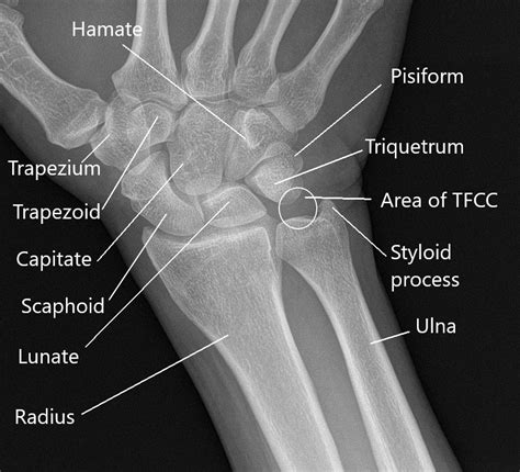 Wrist Pain Causes And Management Complete Orthopedics