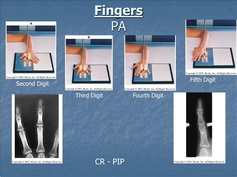 Fingers Pa X Ray Polymed Lab
