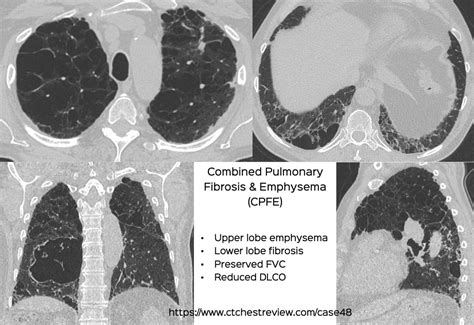 Case 48 Combined Pulmonary Fibrosis And Emphysema Cpfe
