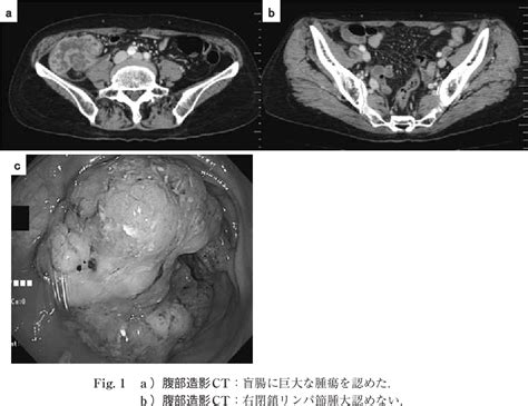 figure 1 from a case of cecal carcinoma involving isolated metastatic recurrence in a right